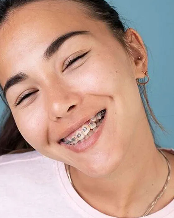 Traditional Metal Braces