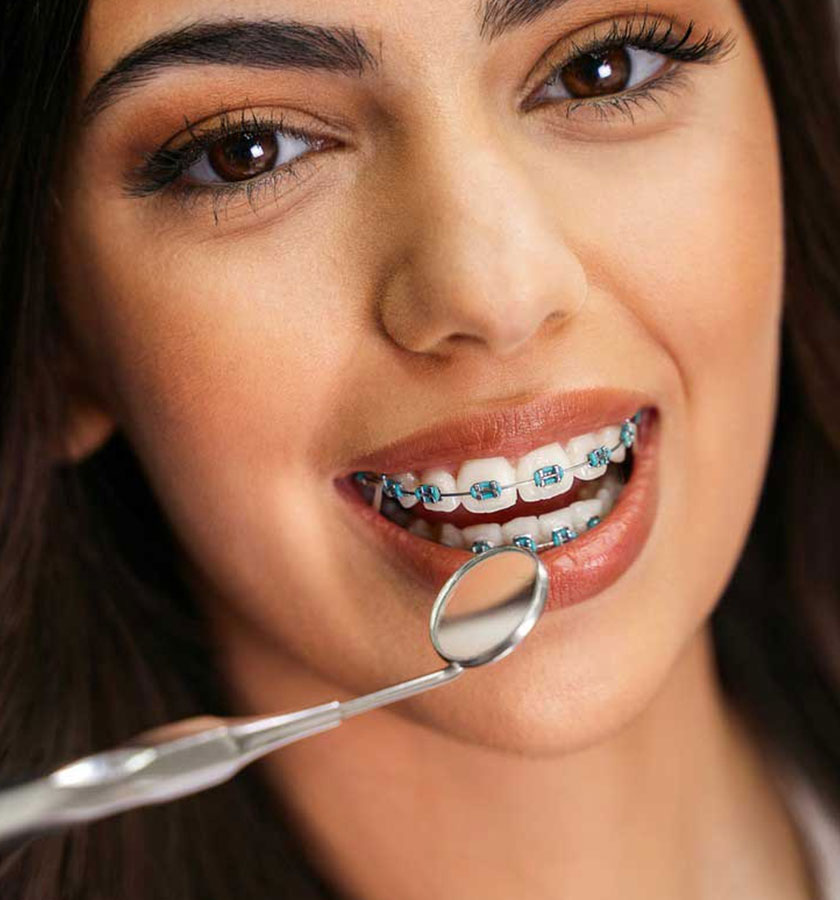 Benefits of Braces
