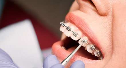 img-newsmile-treatment-braces-howwork-adjusment