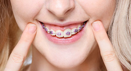 img-newsmile-treatment-braces-howwork-placement