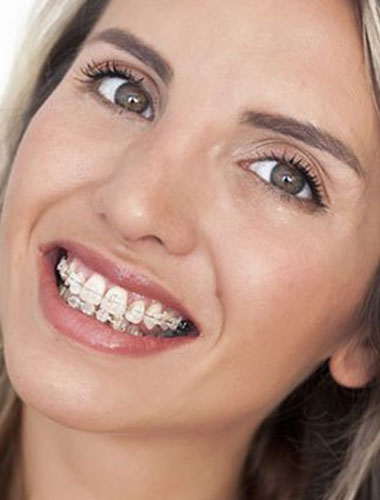 img-newsmile-treatment-ceramicbraces-whatisceramicbraces