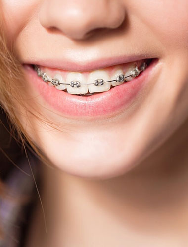 img-newsmile-treatment-traditionalbraces-howwork