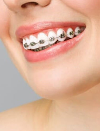 img-newsmile-treatment-traditionalbraces-whatistraditionalbraces