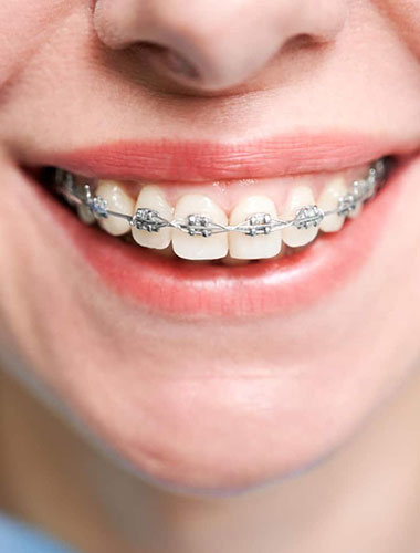 img-newsmile-treatment-traditionalbraces-whynewsmile