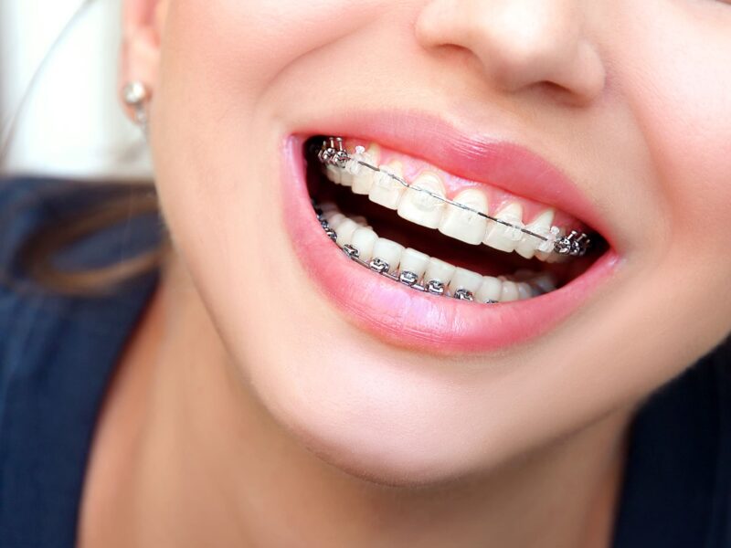 clear braces near me