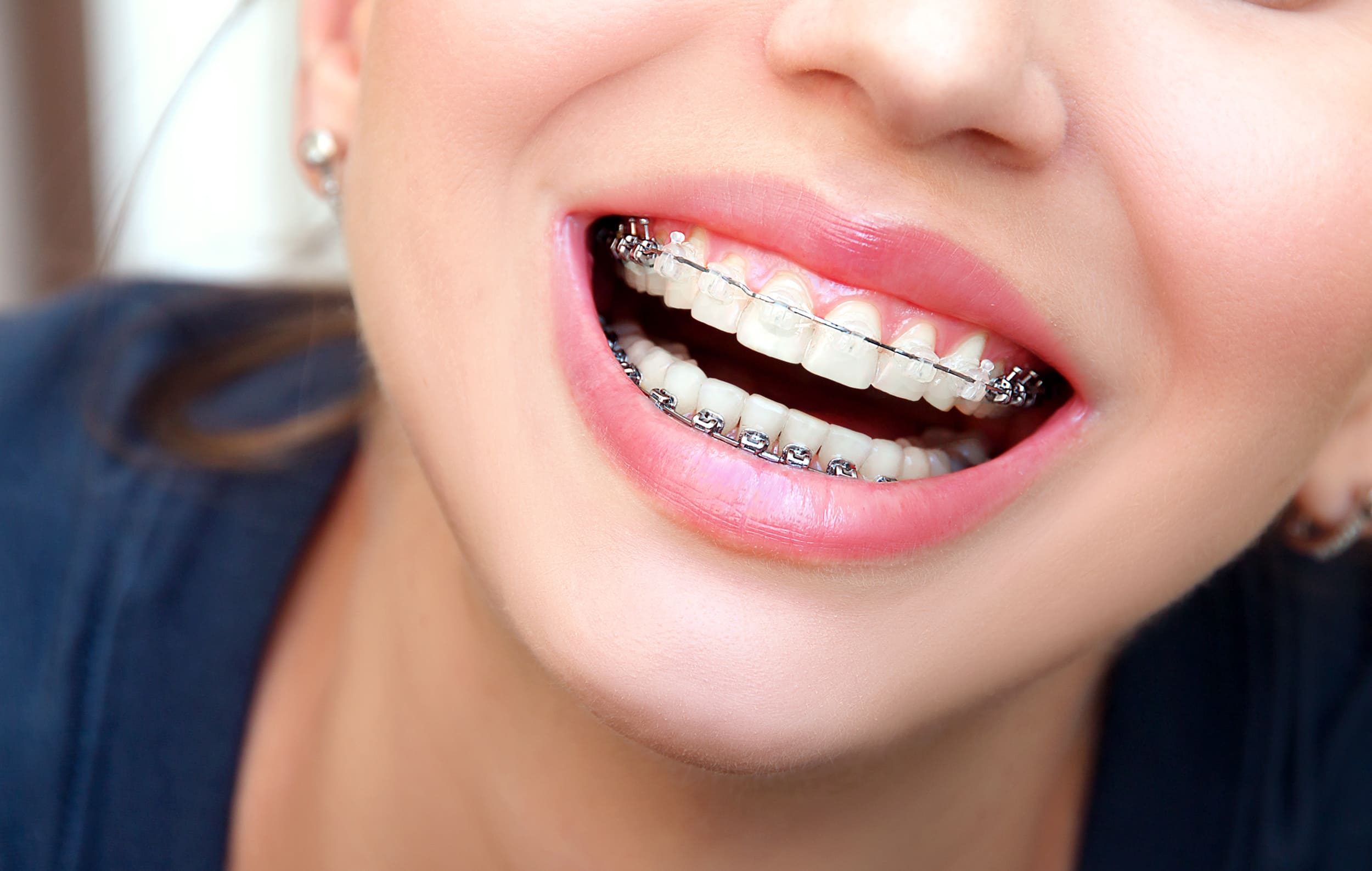 clear braces near me