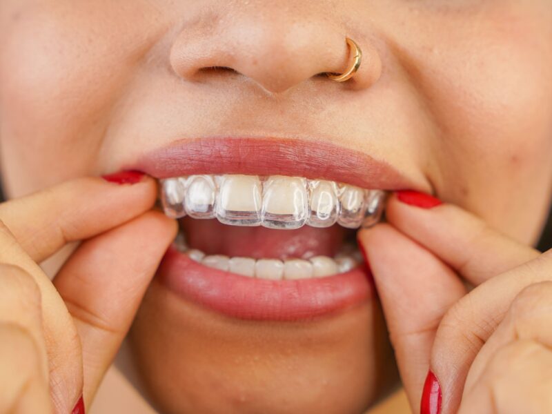 invisalign in Tracy and Manteca CA