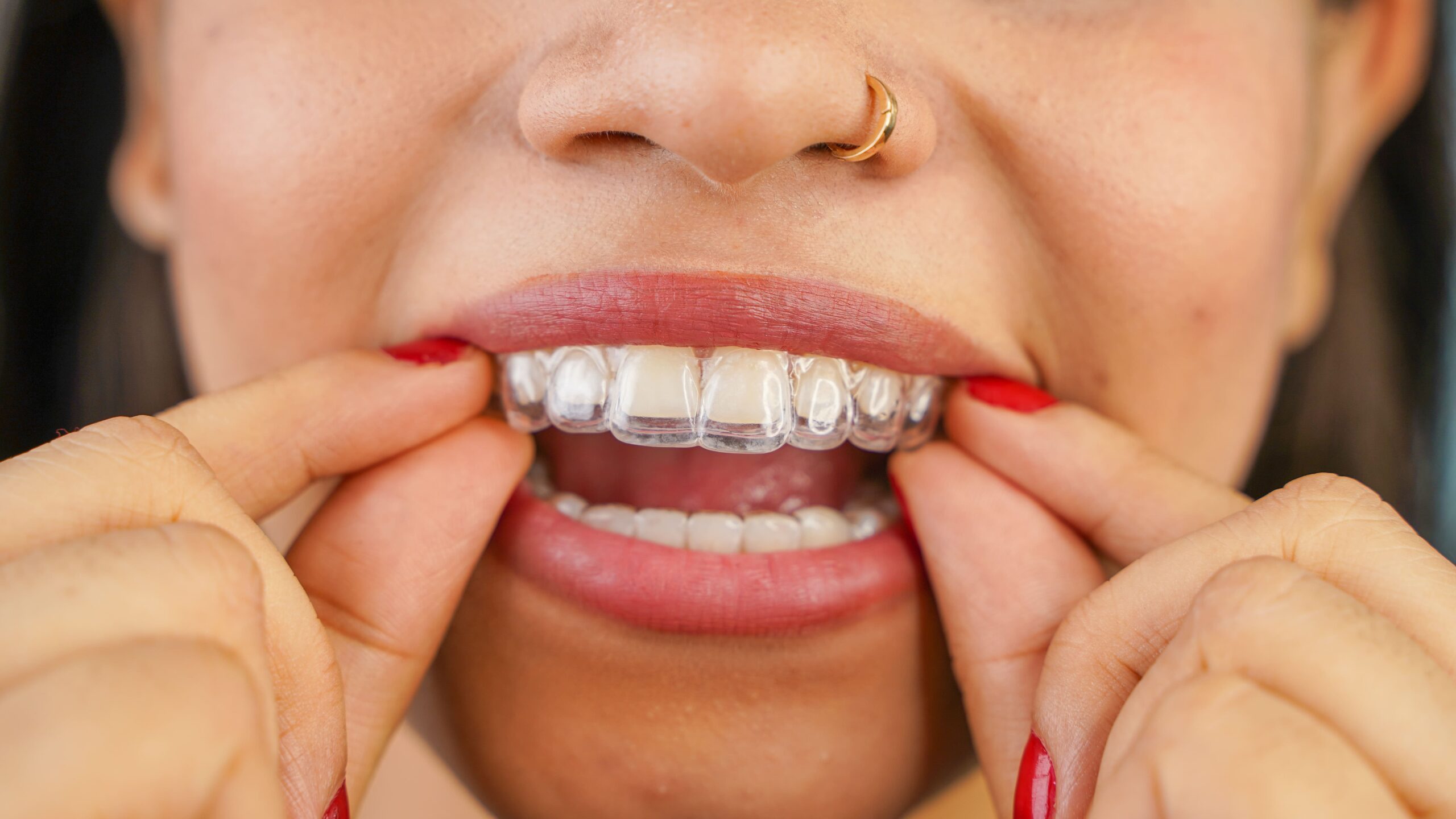 invisalign in Tracy and Manteca CA