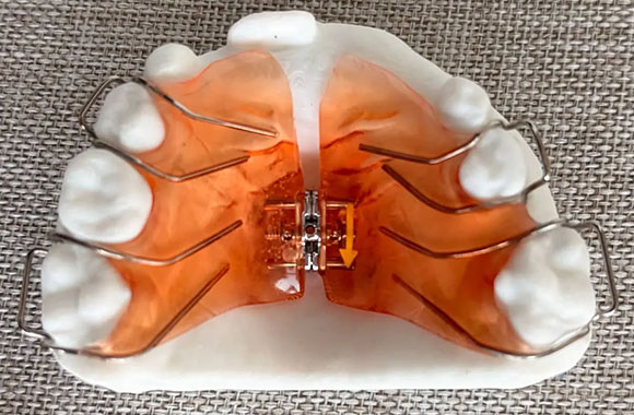 img-newsmileortho-palatalexpander